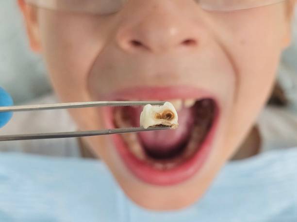 Best Emergency Dentist for Lost Fillings or Crowns in Forest Heights, TX